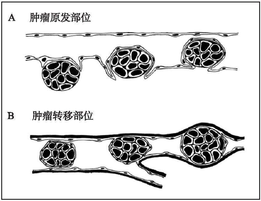 四、良性腫瘤與惡性腫瘤的區(qū)別